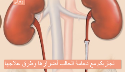 تجاربكم مع دعامة الحالب أضرارها وطرق علاجها